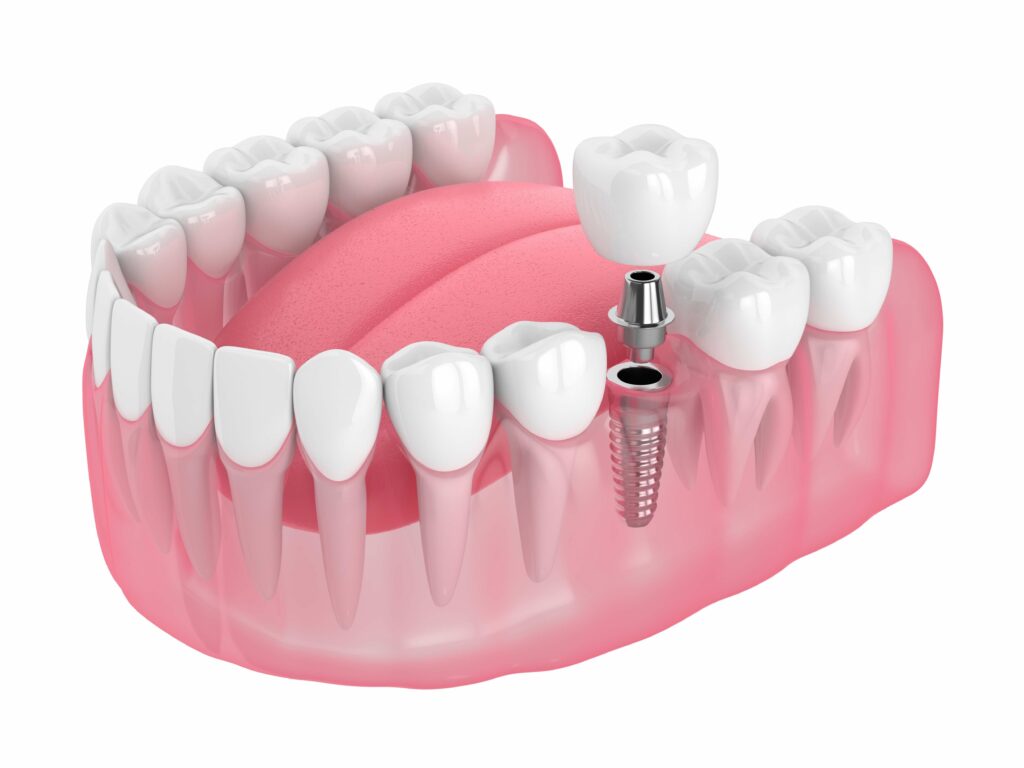 Dental Implants Hurst Texas