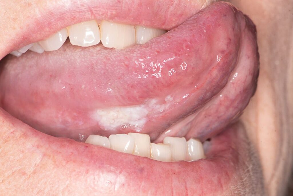 Oral Cancer Hurst Texas HEBDENTAL