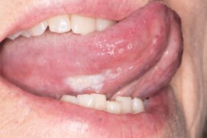 Oral Cancer Hurst Texas HEBDENTAL